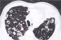 肺上考虑转移瘤是什么意思,肺转移瘤知识讲座