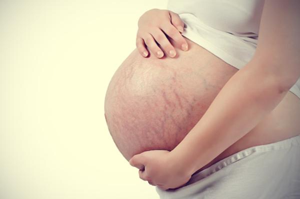 孕妈妈妊娠纹怎么缓解,孕妈妈长纹了怎么办