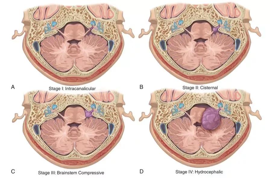 听神经瘤突聋能恢复吗,听神经瘤耳聋了怎么办