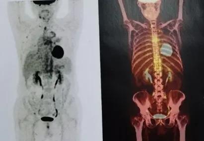 咳嗽咳痰胸腔积液10月余治疗无效，艰难追踪得出哪些教训？（上）