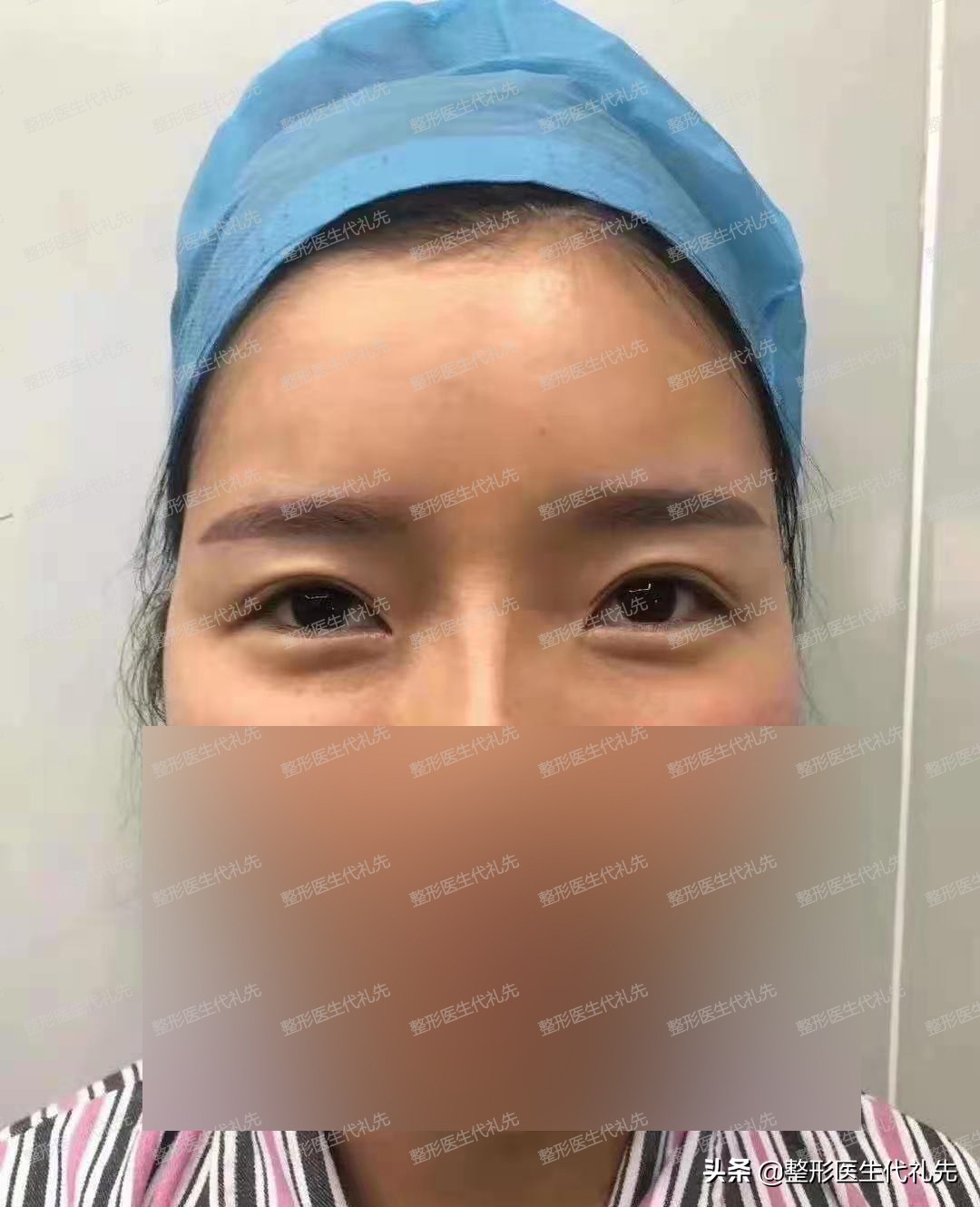 聊一聊眼睛手术,双眼皮怎么选看完你就知道了