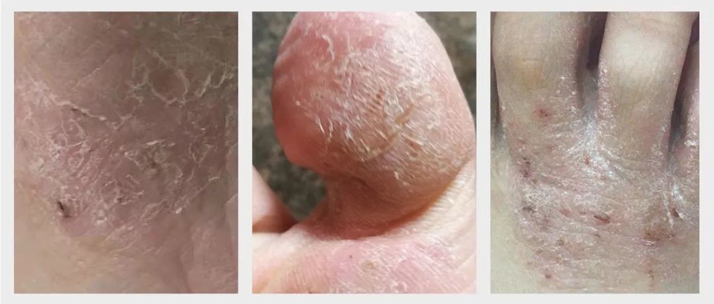 脚气脚臭脚痒的治疗方法小妙招,有脚臭脚痒裂口的脚气症状怎么治