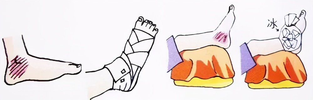 踝关节在崴脚是经常内翻还是外翻,经常崴脚怎么加强踝关节力量