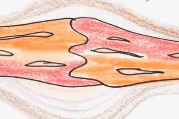 骨科张医生骨质增生,骨科赵医生骨质增生