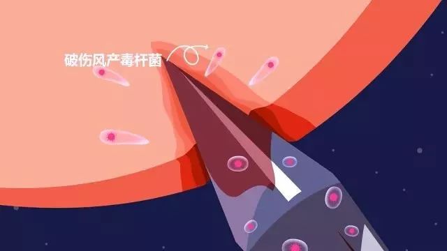 怎么才能知道自己有破伤风,破伤风那些事微视频