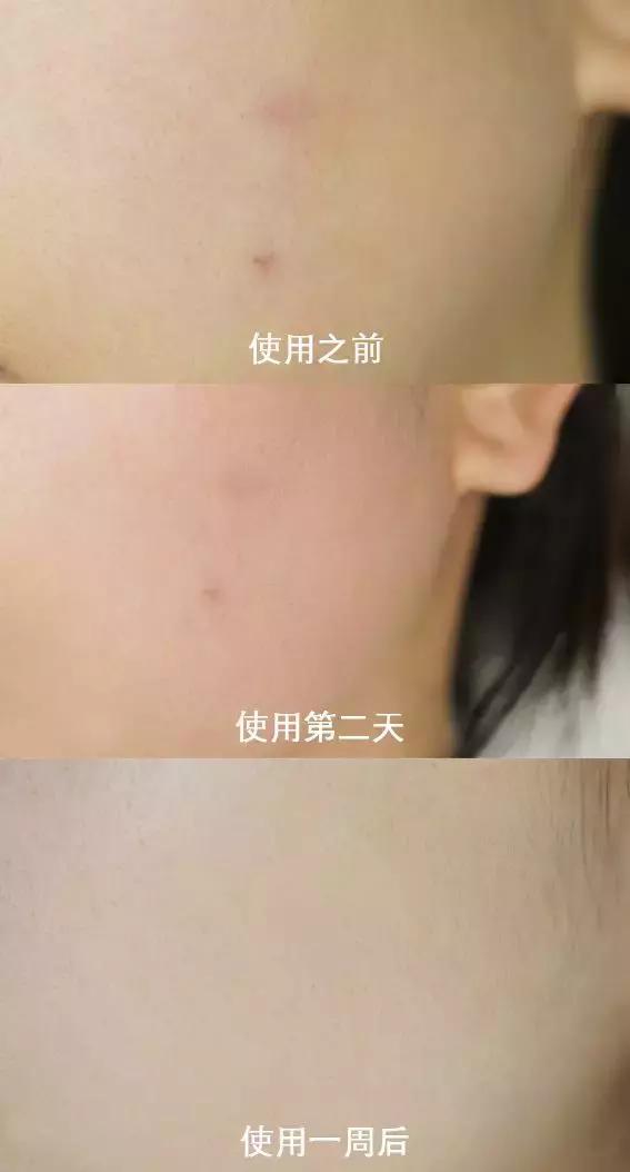 好用祛痘产品评测,抗痘最好的产品排行