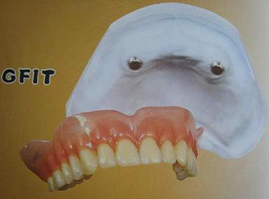 现在最便宜的假牙多少钱一颗,目前国内最好的假牙是多少钱