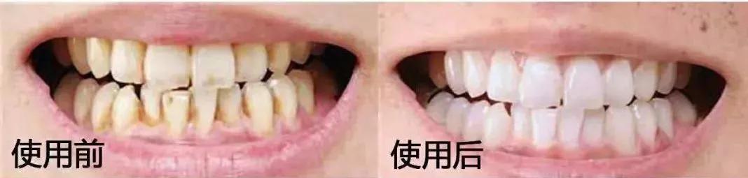 刷牙怎么刷能立刻从黄牙变成白牙,刷牙白牙小妙招