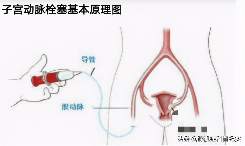 这4种手术治疗腺肌症的利弊你知道吗?