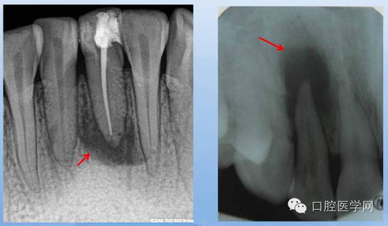 根尖周炎能自愈吗,根尖周炎x光图片