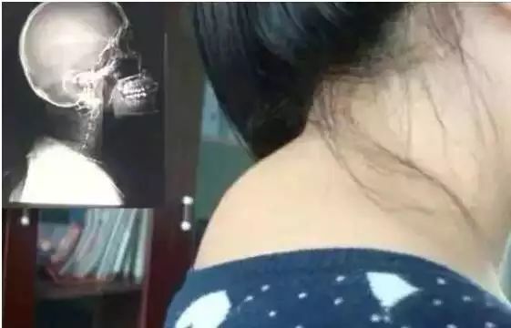 李可老中医治疗富贵包,老中医富贵包视频