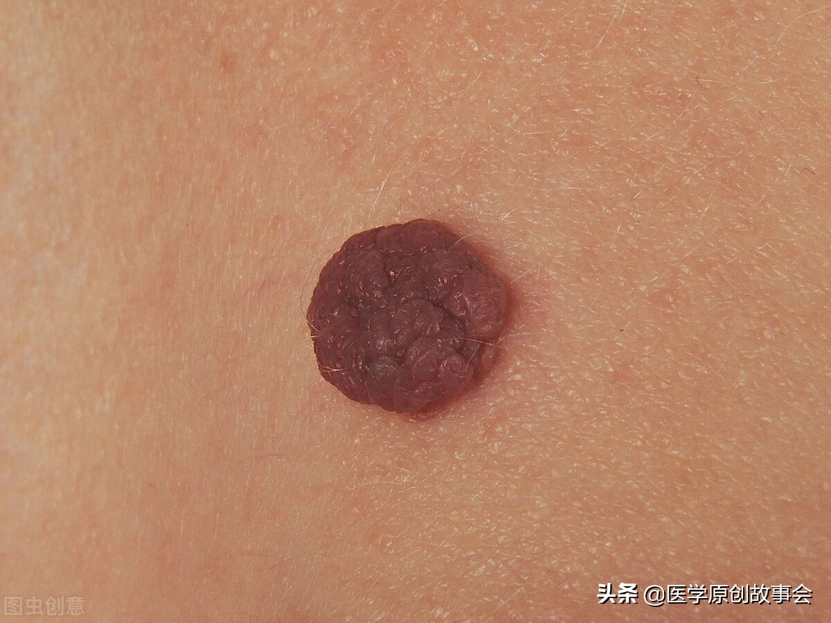 皮肤上长出一个个小肉球是怎么回事，可以抠掉吗？如何处理？