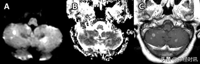 脑卒中的快速识别ppt,脑卒中神经影像学实例解析