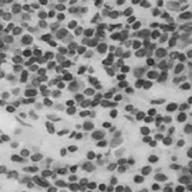 脊髓压迫骨髓,压迫脊髓必须做手术吗