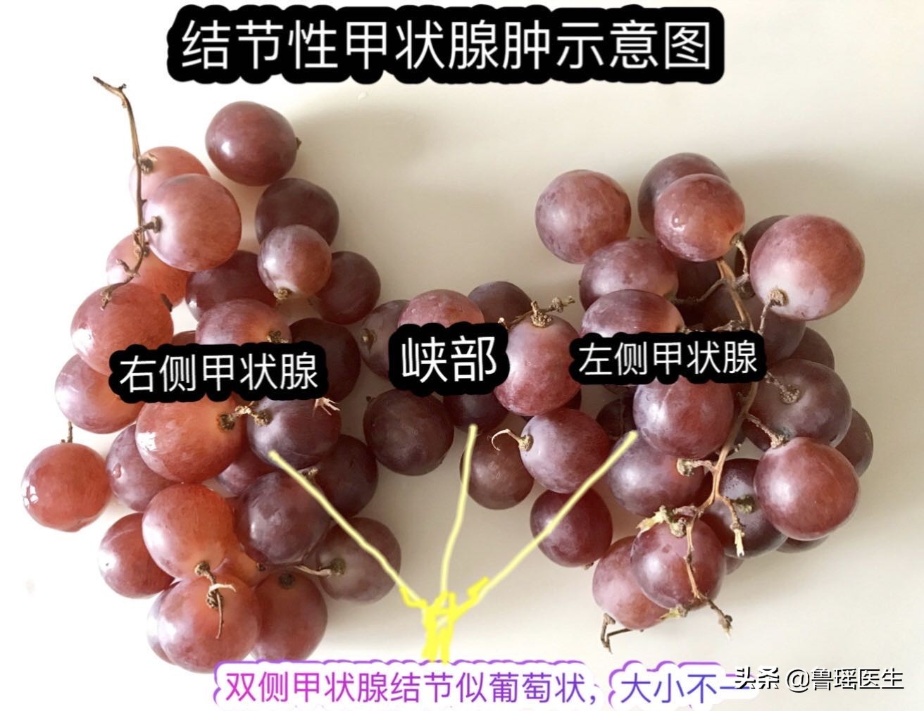 甲状腺结节靠近气管一定要手术吗,甲状腺结节多大才会压迫气管