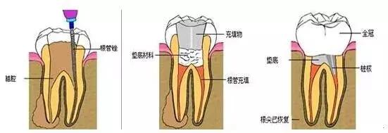 补牙4年后钻心的痛怎么回事,补牙一两年后出现疼痛什么原因