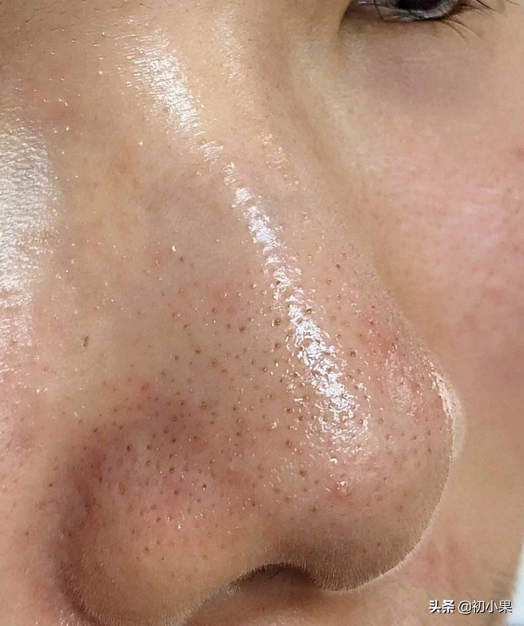 鼻子上的黑头怎么去除,鼻子上的黑头怎么去除儿童