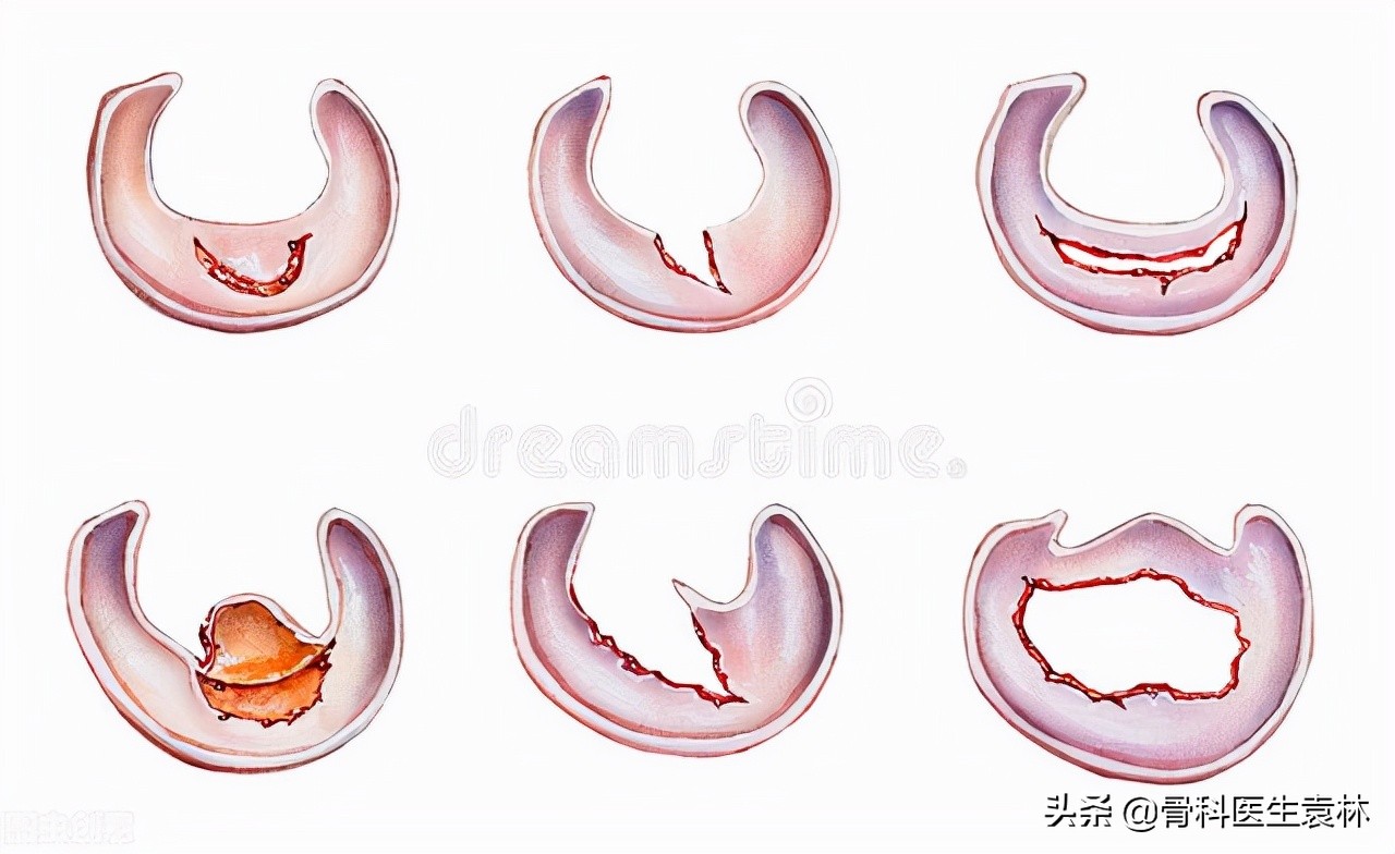 半月板缝合手术费用大概多少钱,半月板缝合手术费用大约多少