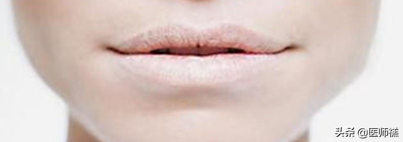 脸上长痘痘缺乏什么维生素,缺少维生素脸上的表现