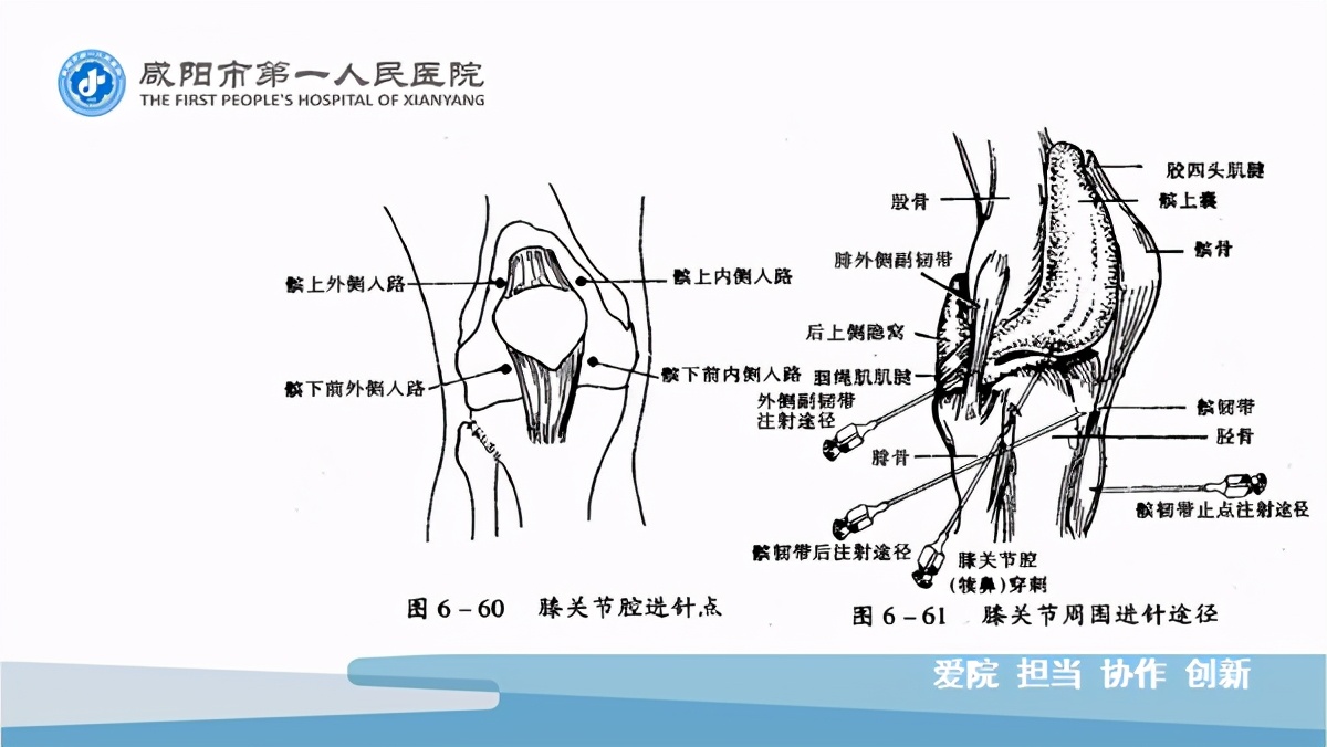 臭氧玻璃酸钠治疗膝关节炎怎么样,膝关节滑膜炎臭氧