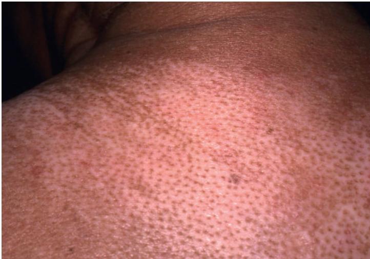 系统性硬化症/硬皮病是什么样的疾病?