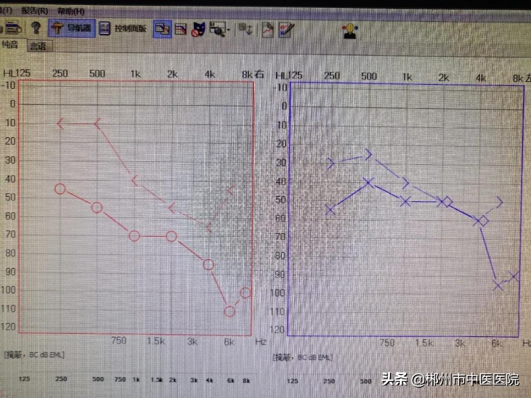 突发性耳聋治疗贵在及时,突发性耳聋要注意哪些