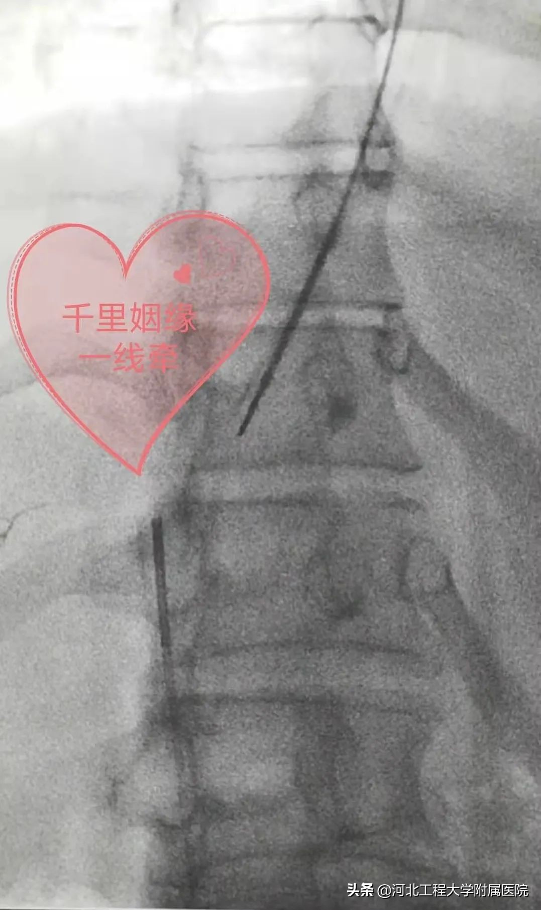 河北工程大学附属医院多学科诊疗,河北省布加氏综合征