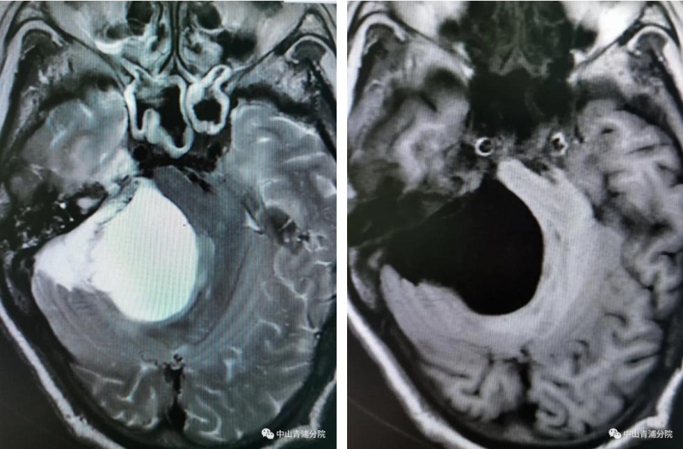 几度风雨人生,听神经瘤患者自述