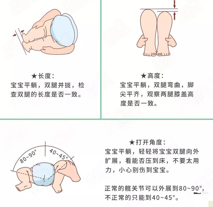 髋关节发育不对称怎么办,腿纹不对称髋关节发育不良