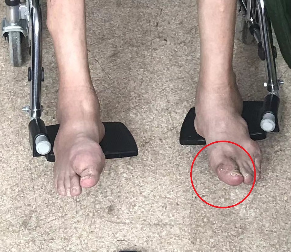 痛风石能挤碎吗,痛风石破溃后能自行愈合吗