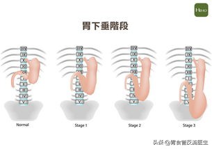 生活习惯对肠胃的危害,哪些生活习惯会对胃造成伤害