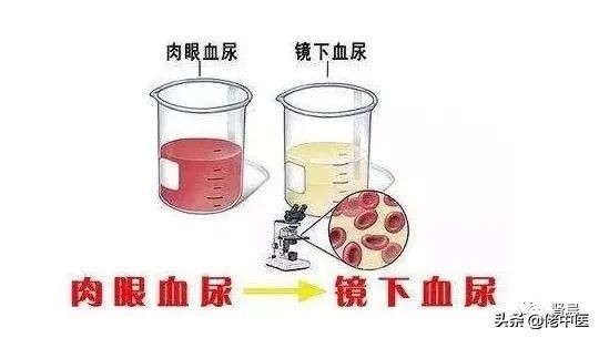 iga肾炎有血尿是不是很严重,iga肾病出现血尿是不是病情加重了