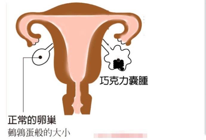 肚子里能长“巧克力”？没有骗人，是真的！