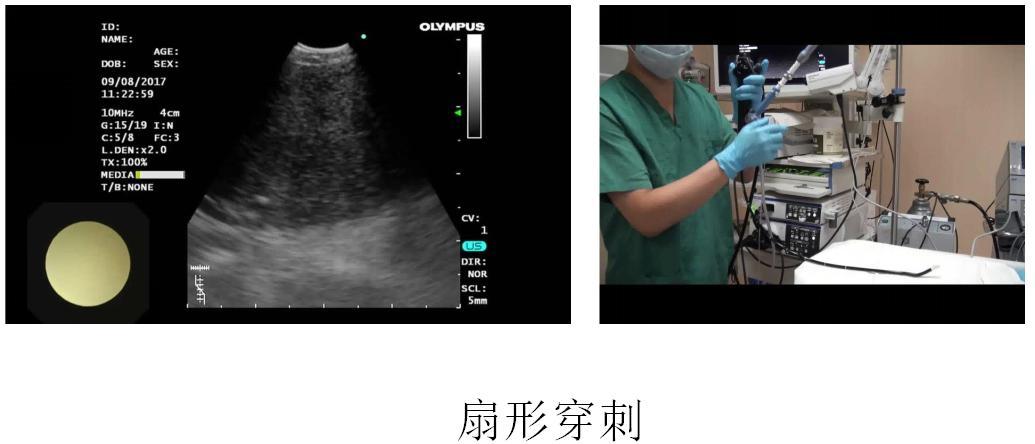 小细胞肺癌的气管镜介入治疗,导航支气管镜在肺癌诊断中的应用