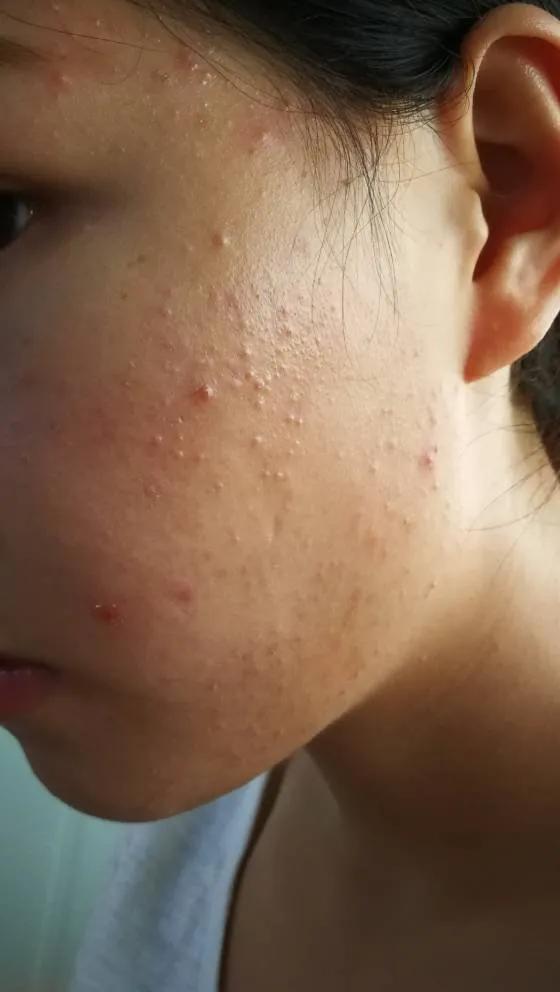 带你了解闭口的出生到消失，教你如何把闭口扼杀在摇篮里