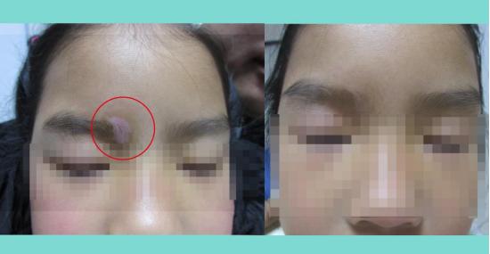 白癜风开始不明显,白癜风不痛不痒