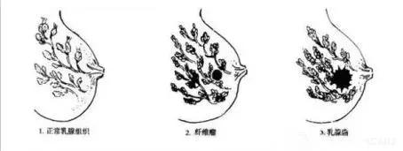 乳房肿块和纤维腺瘤,乳腺纤维腺瘤肿块有无血流信号