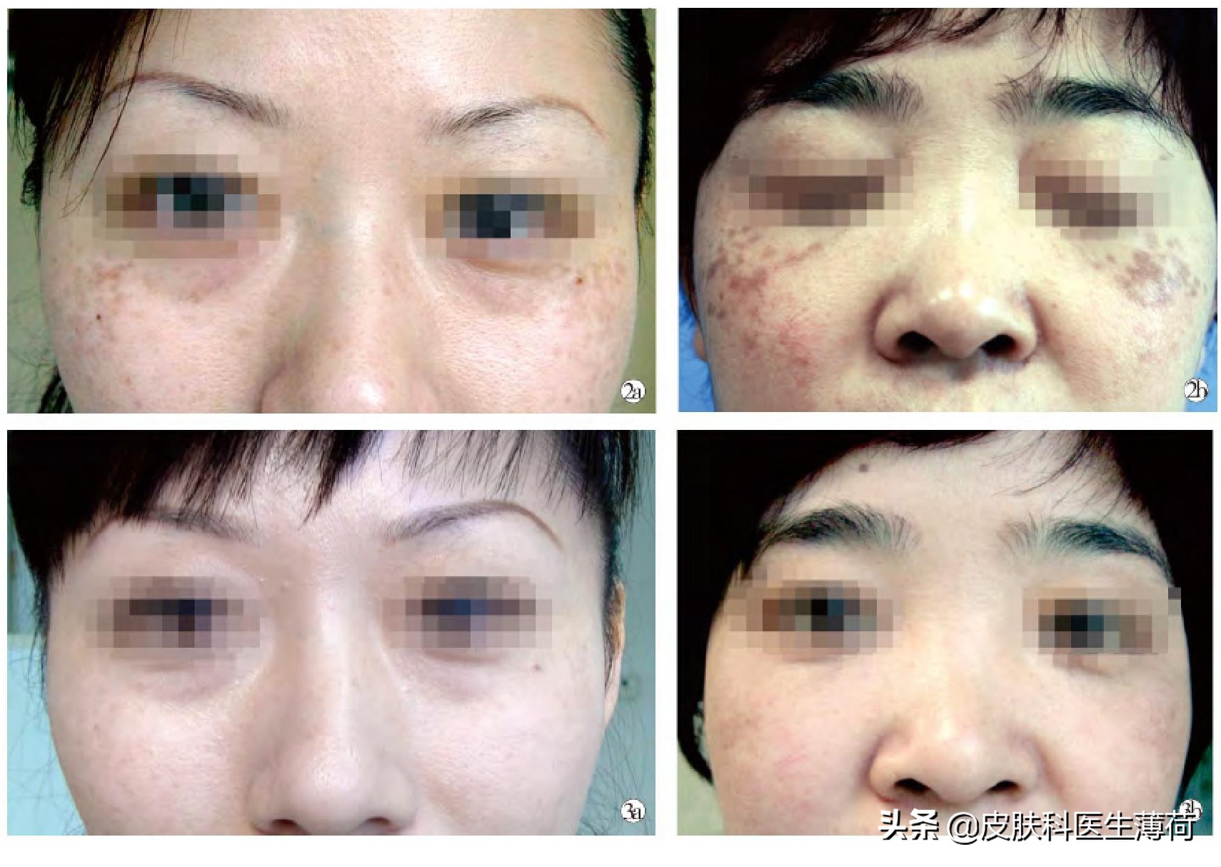 皮秒激光祛雀斑效果图,激光祛痘坑效果