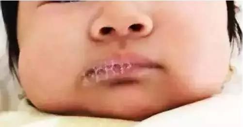 宝宝脖子反反复复发红,宝宝脖子总是泛红怎么回事