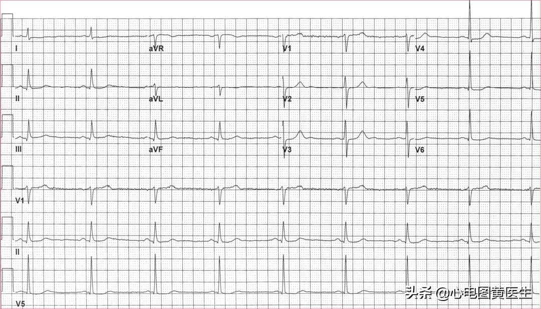 心电图左室高电压t波改变,心电图显示左室高电压和t波改变