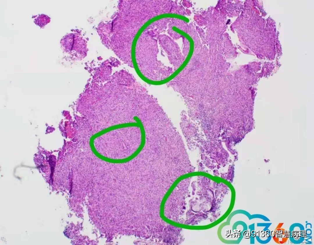 宫颈腺癌silvaa型严重吗,宫颈腺癌silvab型复发率高吗