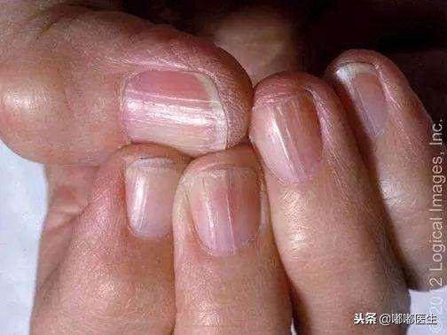 指甲有白点肚子里有蛔虫？月牙越大越健康？指甲软是缺钙……