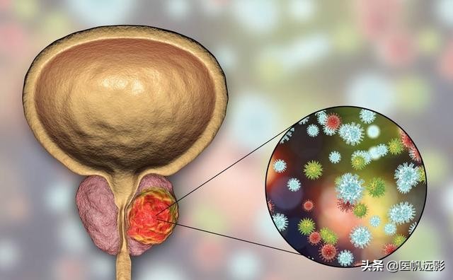 为什么性功能有问题却拿前列腺开玩笑?