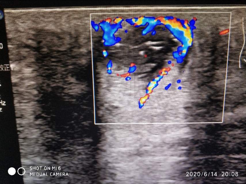 骶尾部硬包就是藏毛窦吗,骶尾骨藏毛窦和囊肿区别