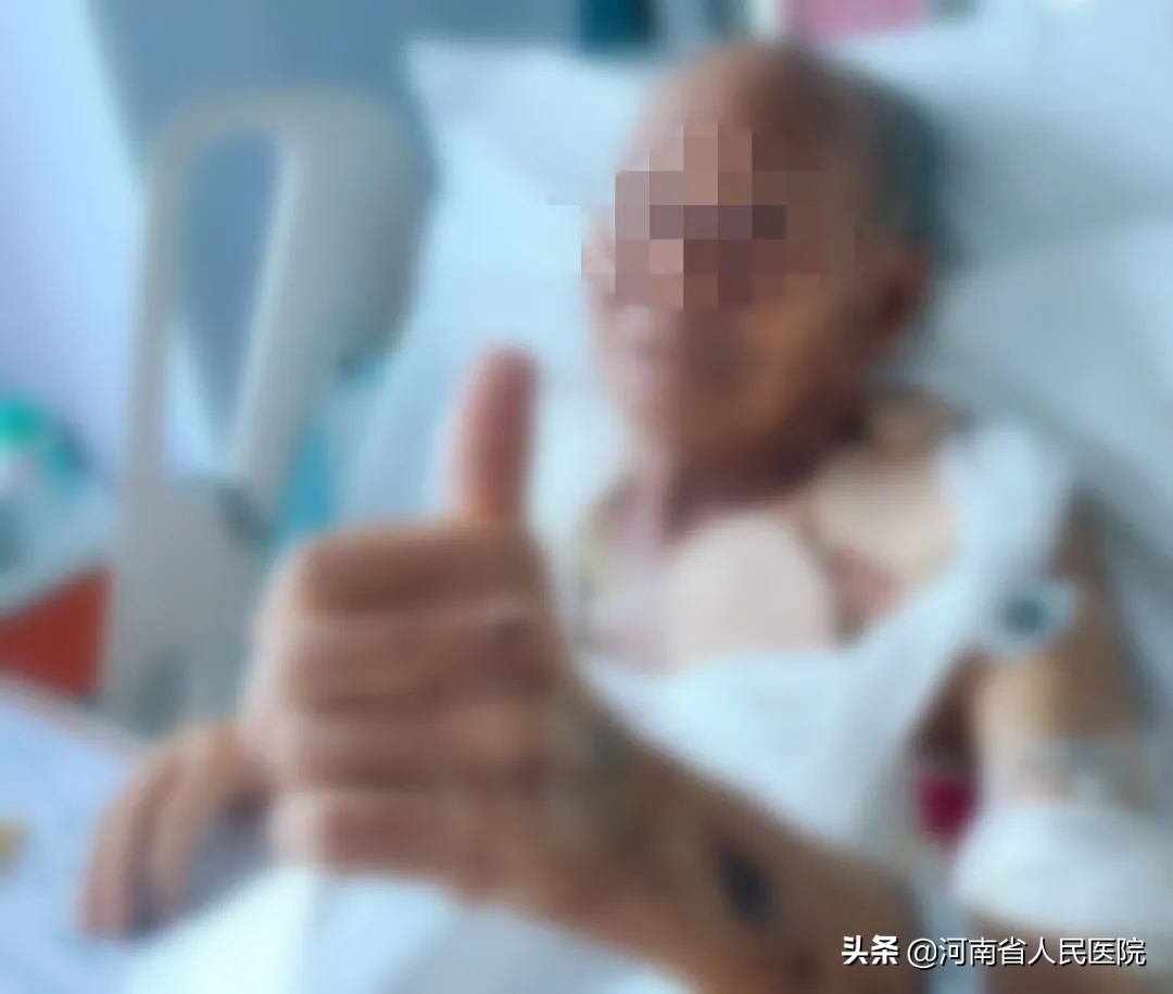 全身换皮手术后续,全身烧伤了换皮能复原吗