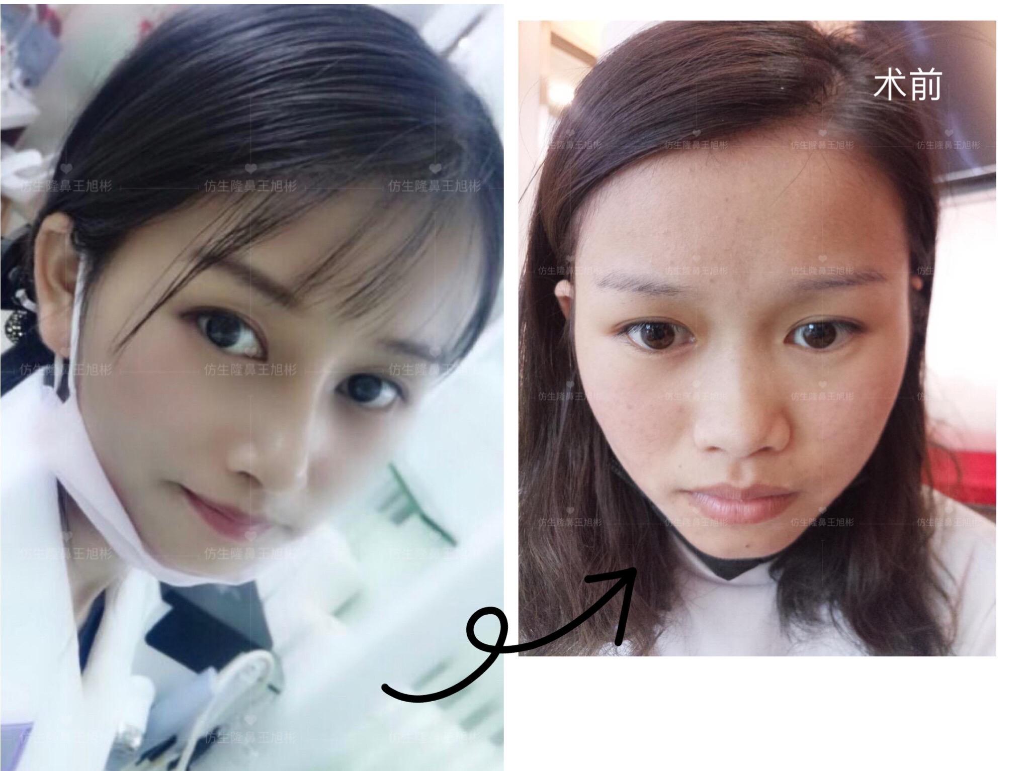 山根低鼻头大隆鼻,鼻根很低的隆鼻后的效果