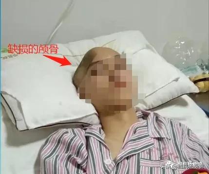 意外伤害很严重年纪轻轻难保命，谭院刀刀用真情豫南名医中中中