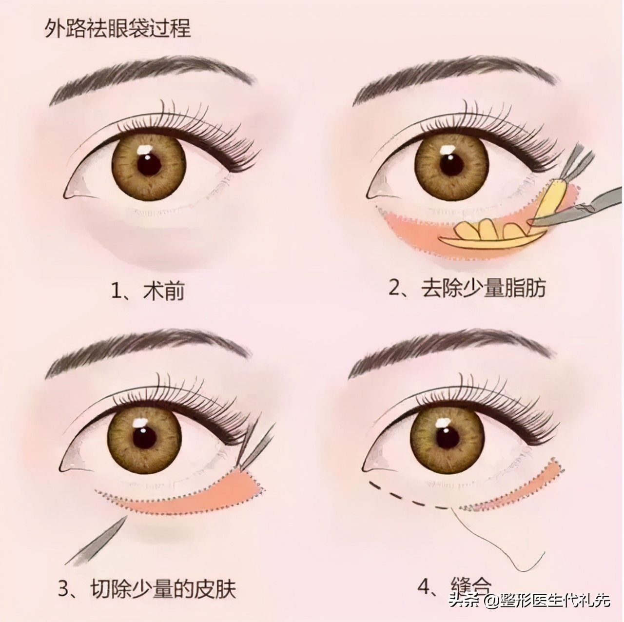 问一下有什么方法快速消除眼袋,关于眼袋的去除方法