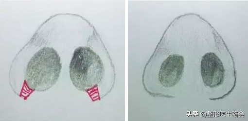 鼻翼缩小会有什么影响,鼻翼缩小会不会影响鼻子呼吸