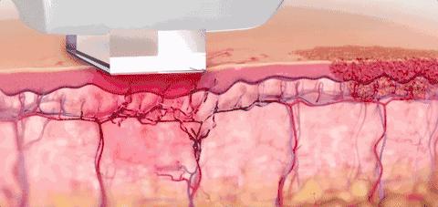 光子嫩肤几岁开始打比较好,光子嫩肤需要一直做一辈子吗